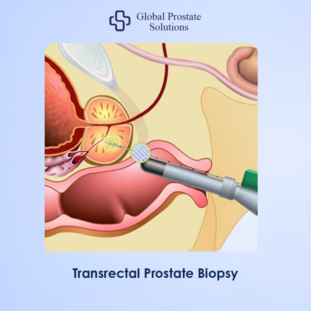 Trans Rectal Prostate Biopsy