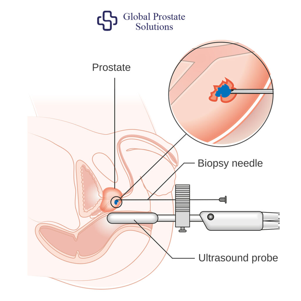What is a Prostate Biopsy