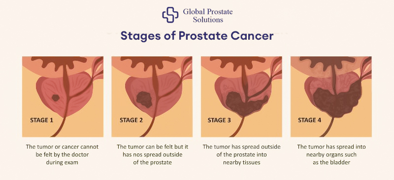 4 Stages of Prostate Cancer