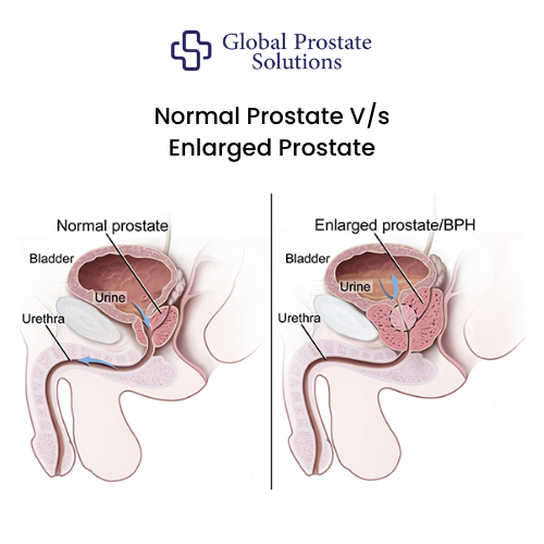 Does an Enlarged Prostate Affect a Man Sexually