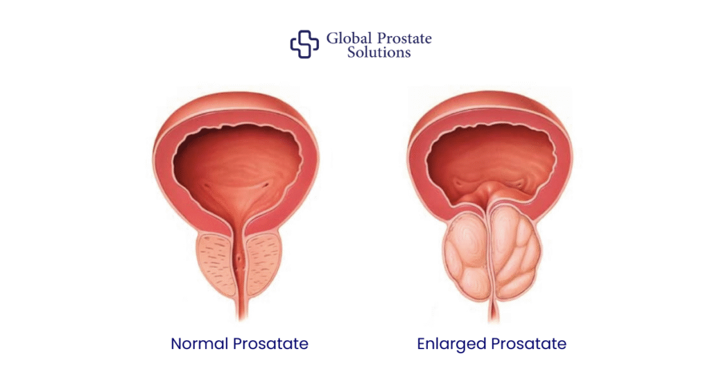What is Prostate Enlargement