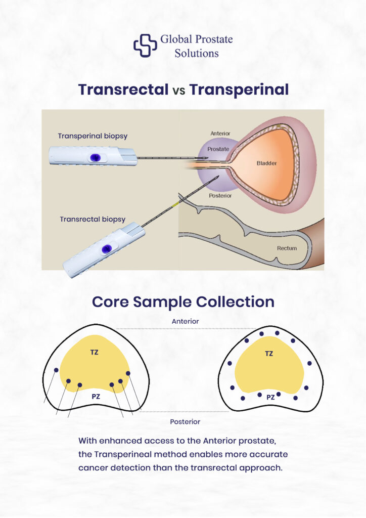 Differentiate Transperineal vs. Transrectal Prostate Biopsy