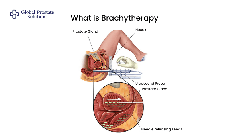 What is Brachytherapy for Prostate Cancer?
