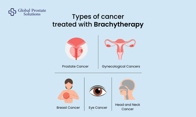 Types of cancer treated with brachytherapy